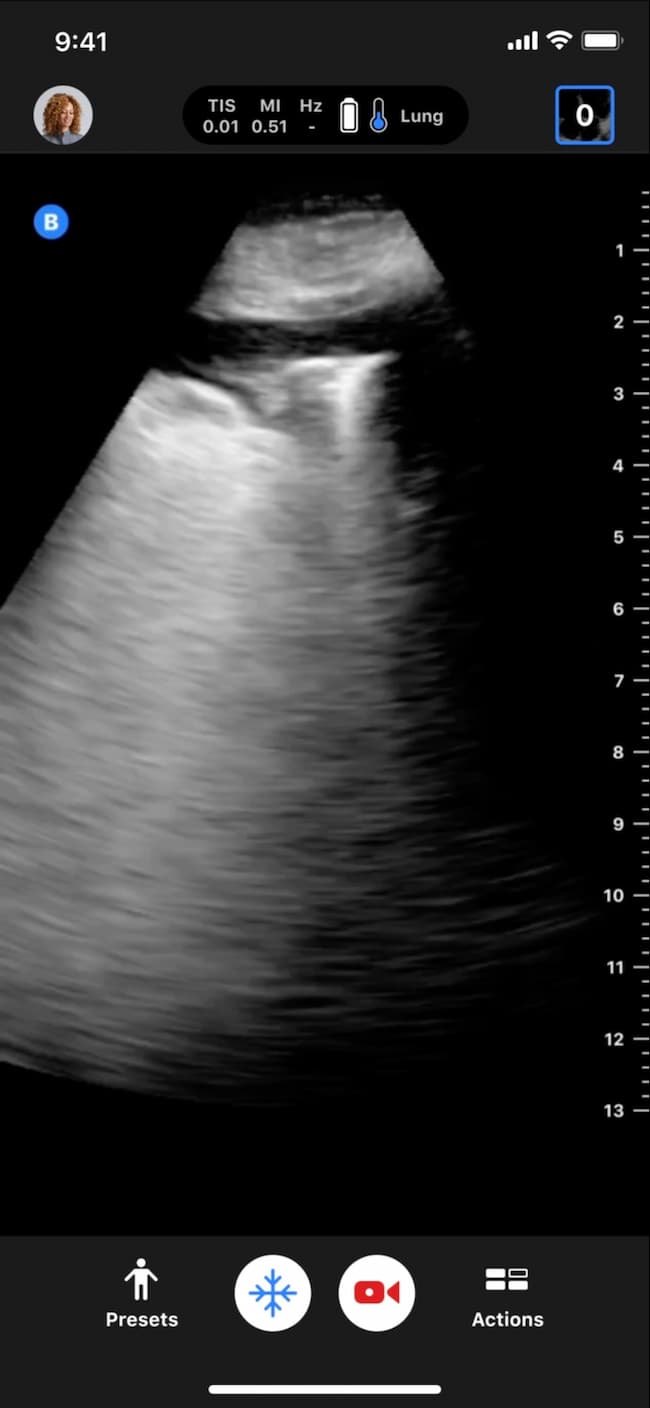 Point of care ultrasound for Primary Care Butterfly iQ3